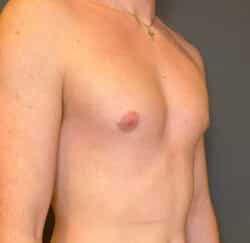 Gynecomastia (male breast reduction)