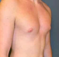 Gynecomastia (male breast reduction)
